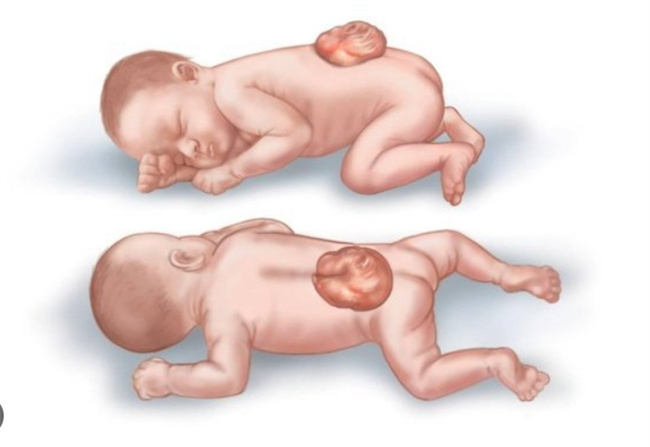 胎儿单肾：关爱之道，从饮食开始