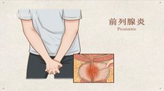 揭秘前列腺炎治疗：多管齐下还你健康
