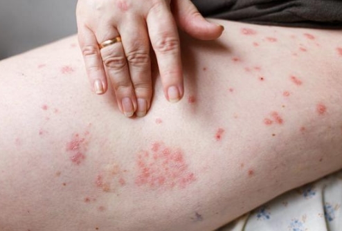 丘疹性荨麻疹与湿疹：了解疾病背后的不同之处