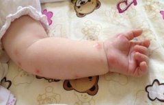 宝宝被蚊子叮咬急救法，妈妈们必备小贴士