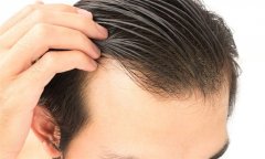 发质内外健康 护发攻略助你告别脱发困扰