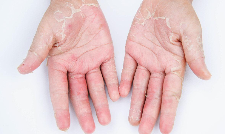 维生素缺乏引起手部脱皮问题的解决方法与护理指南