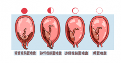 揭秘中央性前置胎盘：了解妊娠期并发症，防范胎盘异常的关键