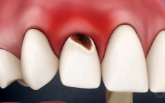 重视口腔健康：严重龋齿的治疗方法详解