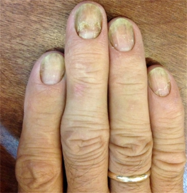 揭秘灰指甲的成因与预防方法
