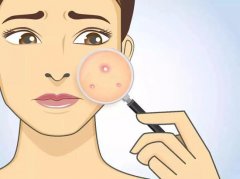 深度解析脸上痤疮成因及科学食疗法