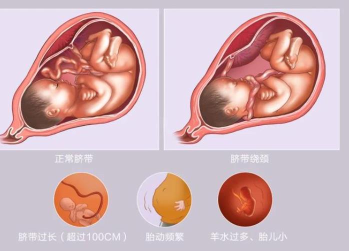 胎儿脐带绕颈，顺产还是剖腹产？