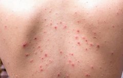 秋儿童丘疹性荨麻疹：红豆点点的痕迹