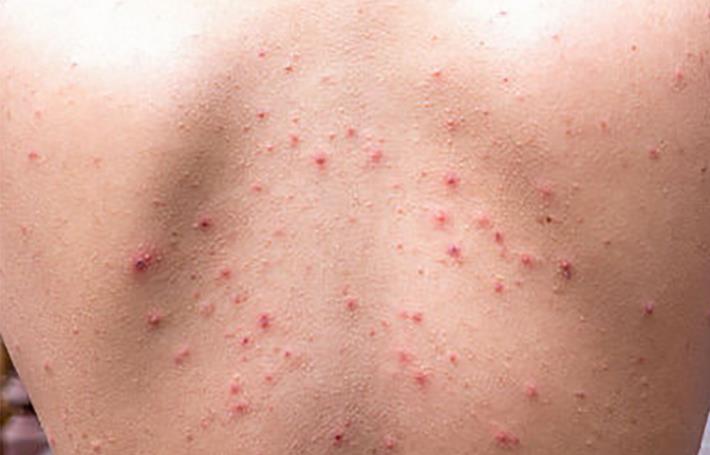 秋儿童丘疹性荨麻疹：红豆点点的痕迹