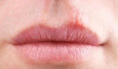 解析嘴唇干燥的原因及专业护理方法