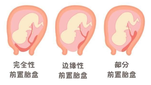 【8大高危险妊娠】为什么前置胎盘要采剖腹产？认识4种前置胎盘、植入性胎盘