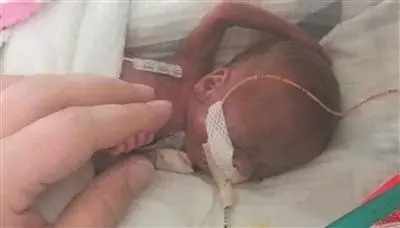 金氏纪录最早产宝宝，提早131天出生、被判定存活率为0，如今1岁生日了！
