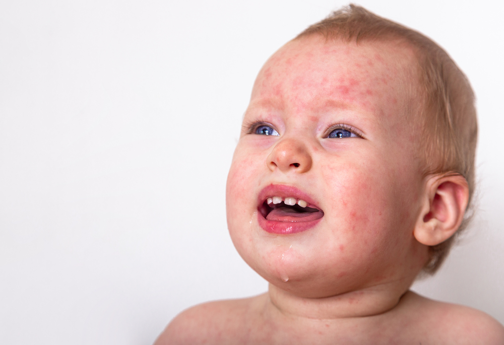 婴儿皮疹发烧: 症状,治疗和预防