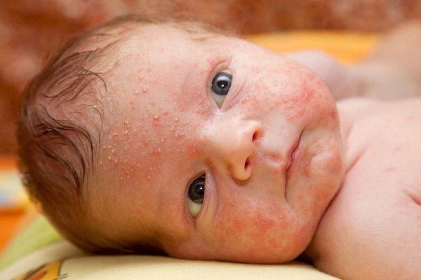 治疗婴儿热疹的20种方法非常有效,安全且易于找到