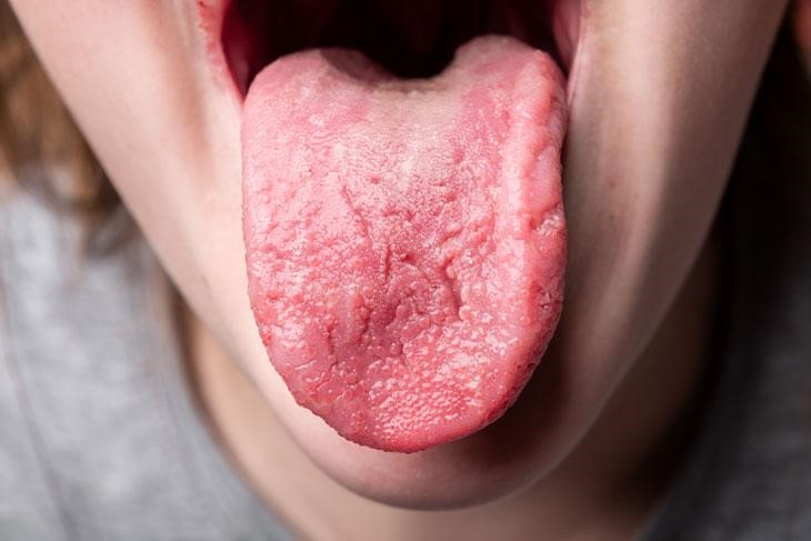 儿童舌头疾病: 妈妈知道更好地预防孩子