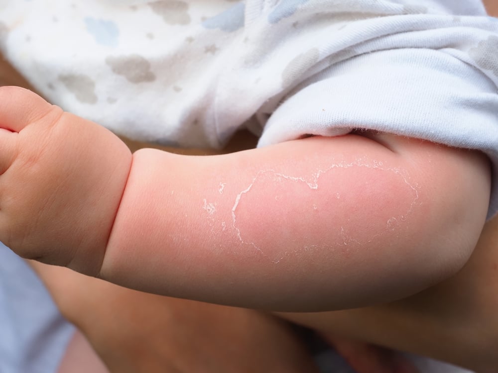 婴儿脱皮是什么原因?解决方法是什么?