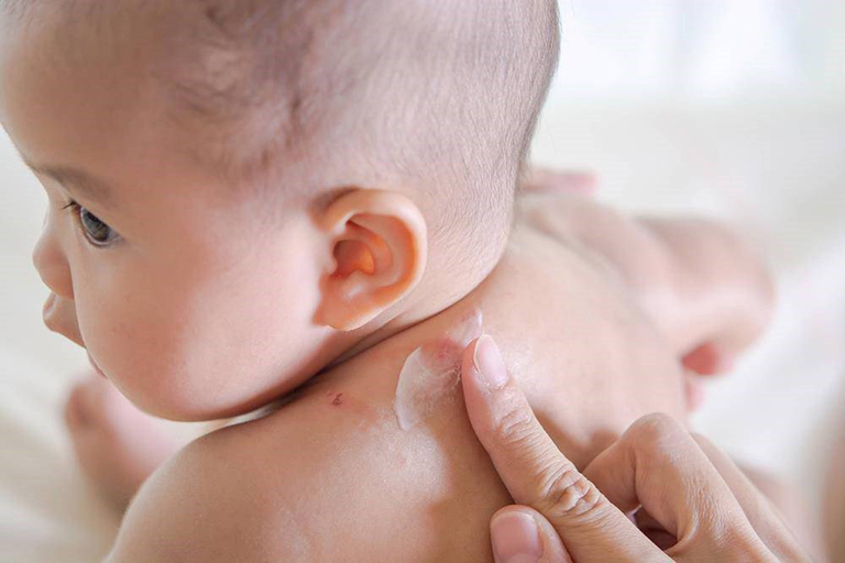 宝宝带状疱疹怎么办?如何治疗儿童带状疱疹?