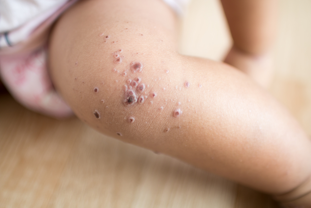 孩子口腔周围有红疹是怎么回事?如何处理