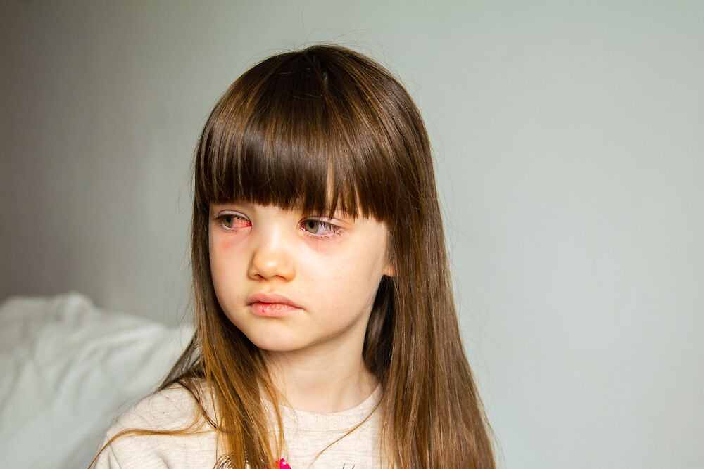 孩子眼睛浮肿是什么原因?父母应该担心吗?