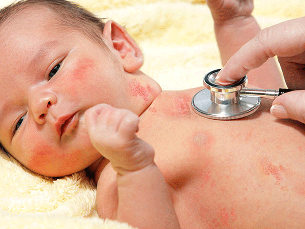 宝宝带状疱疹怎么办?如何治疗儿童带状疱疹?