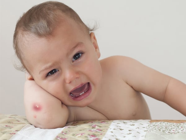 保护婴儿的皮肤免受粉刺