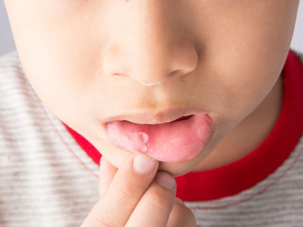 儿童有口腔热,母亲应与手足口病的表现区分开来