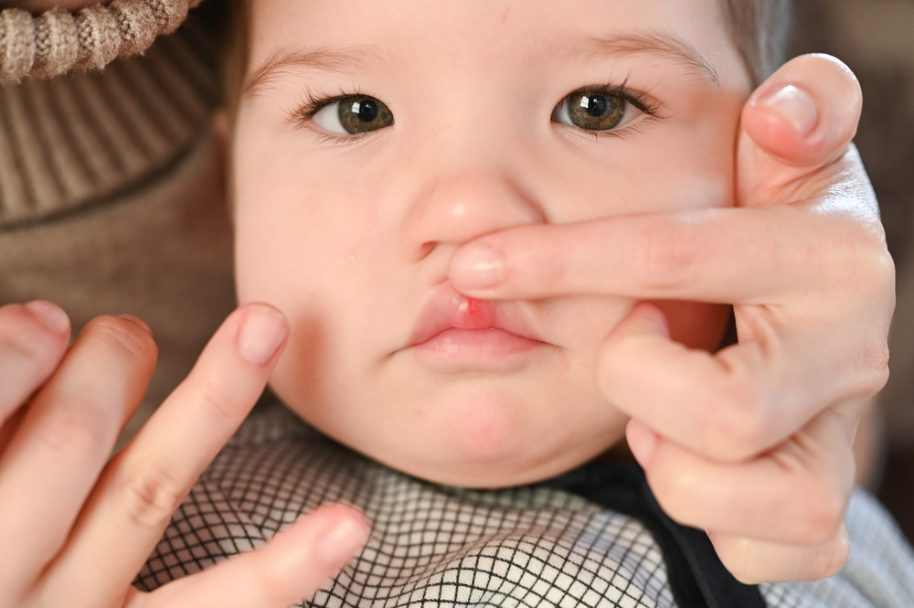 婴儿上唇肿胀: 如何有效,简单和安全地处理