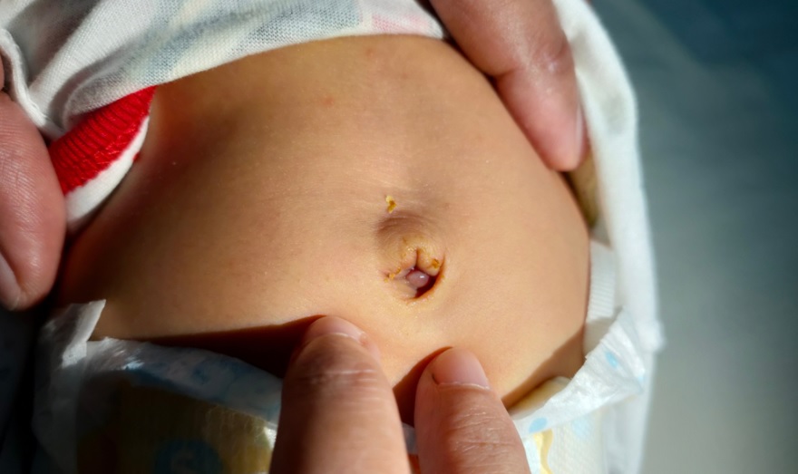 新生儿脐带颗粒肿瘤是否危险以及如何治疗