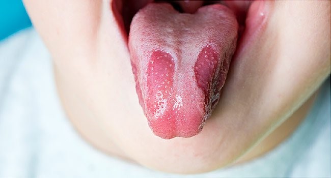 儿童舌头疾病: 妈妈知道更好地预防孩子