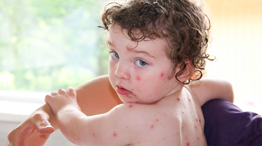 儿童天花与水痘如何区分