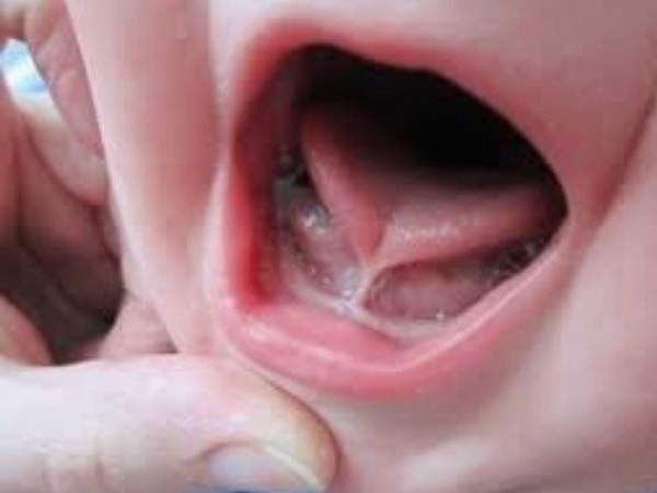 如何识别婴儿的舌头和治疗方向