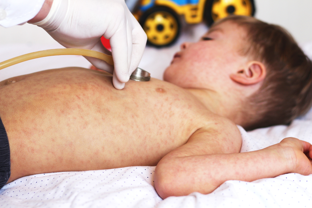 儿童风疹危险,是否需要接种疫苗