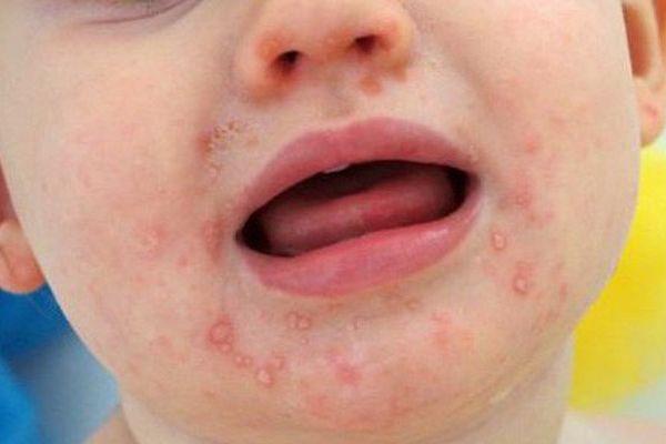 常见的儿童皮肤病及其对儿童健康的影响