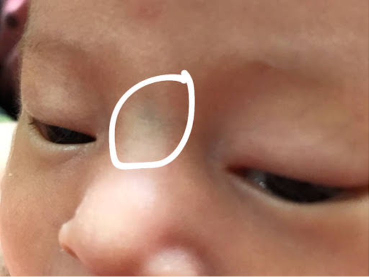 鼻子上有青筋的孩子会让宝宝虚弱吗?