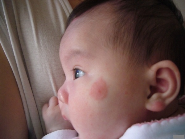 妈妈不要对婴儿皮肤上的昆虫叮咬引起的发红感到主观