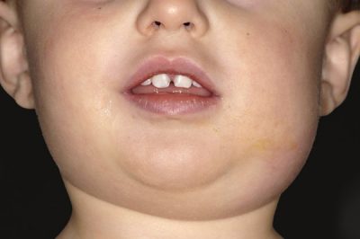 儿童唾液性腺炎: 腮腺炎的症状