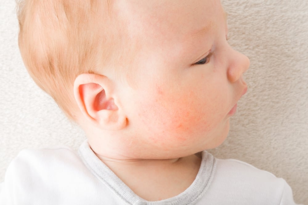 宝宝脸上红疹是怎么回事?原因和治疗