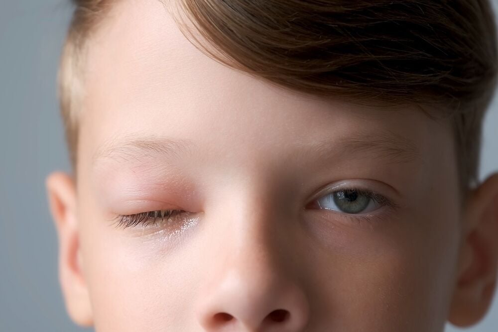 上眼睑肿胀的儿童: 原因和预防