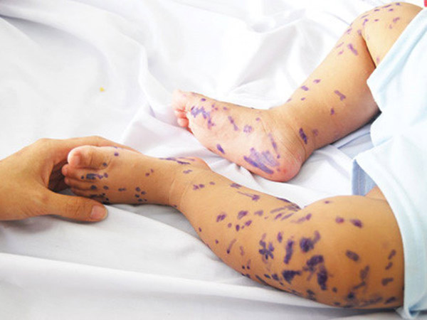 儿童手足口病: 婴儿的体征,治疗和预防