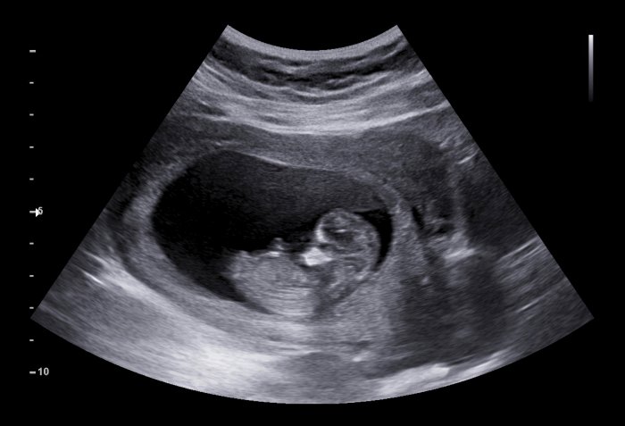 胎儿异常，产检必做7项筛检