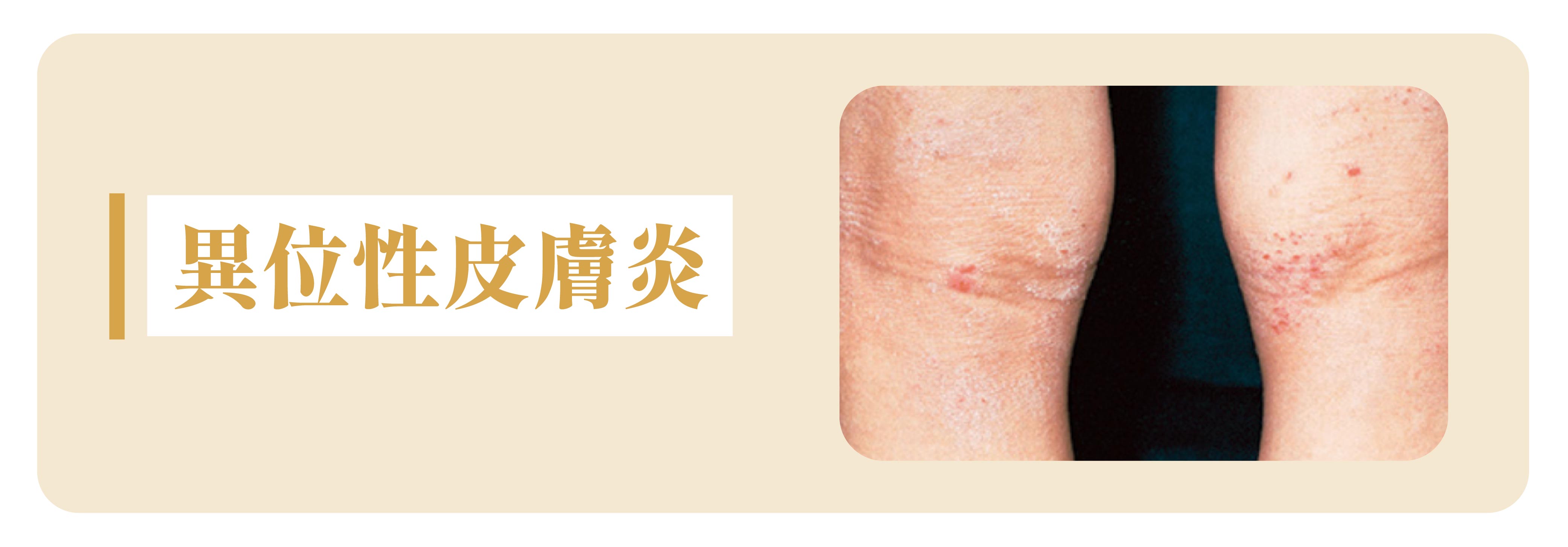 宝宝常见4大肌肤问题和预防护理法日本最权威小儿皮肤科医师山本一哉说给你