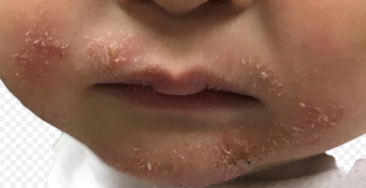 10月大男婴嘴巴周围长红疹，竟是缺锌导致生长停滞！补充锌，3个月长高5公分