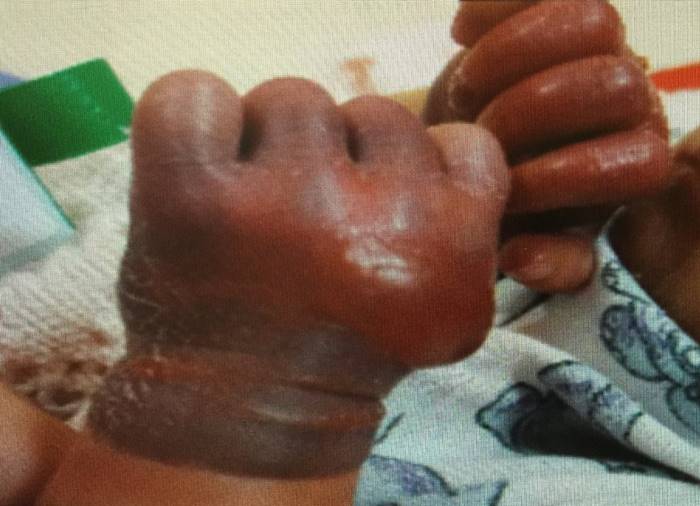 10天大女婴戴防抓手套狂哭闹，妈妈解开后双手竟成缺血性损伤！