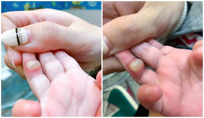 1岁女童常挖鼻孔引来超级细菌，拇指长恐怖脓疱！