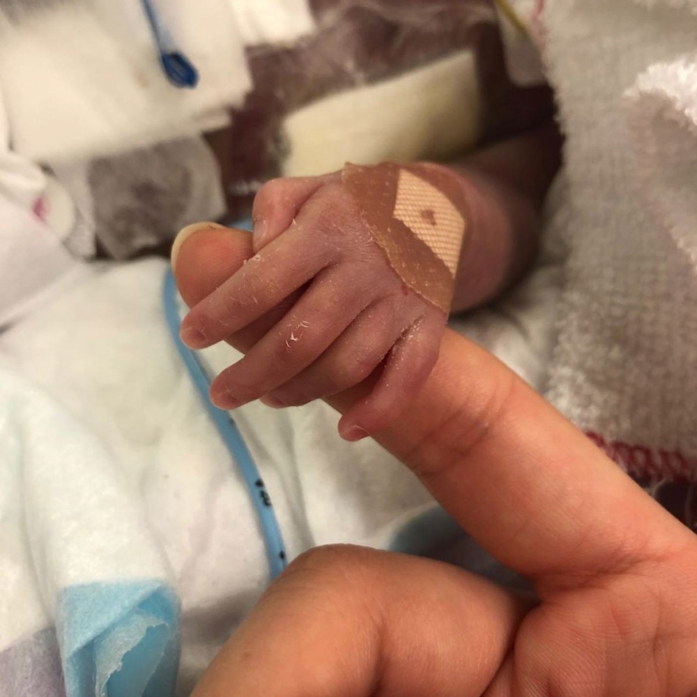 仅29周出生！早产儿彦彦，经历多次手术仍未脱离险境。