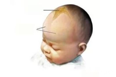 新生儿扫盲：揭头顶乳痂易生病?看卤门了解宝宝