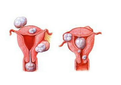 患上子宫肌瘤对胎儿有影响吗