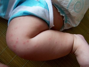 宝宝荨麻疹如何治疗 宝宝荨麻疹可以洗澡吗