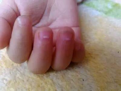 宝宝指甲长白斑、无月牙，哪里有问题？