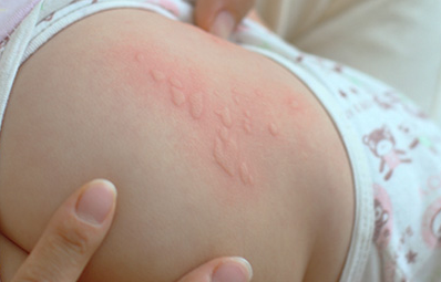小儿麻疹与小儿荨麻疹的区别 小儿麻疹是荨麻疹吗